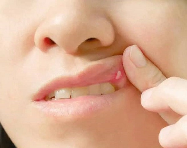 Symptoms of Lip Cancer (symbolic picture)