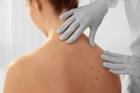 Skin cancer surge older men, global skin cancer increase