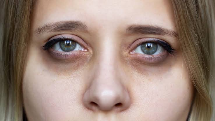 Decode the Dark Circles before you Treat them